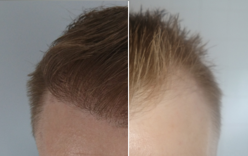 Grow all your hair back at hair transplant clinic