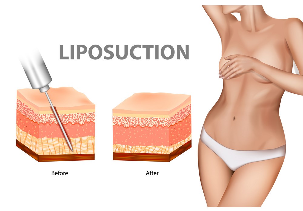 The Best Liposuction In Istanbul Turkey