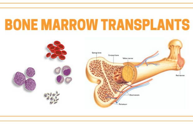 Everything you should know about Bone Marrow Transplant and more