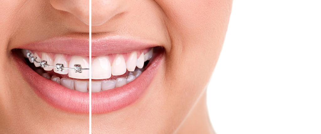 Get a perfect dental solution with Orthodontics Treatment in Turkey 