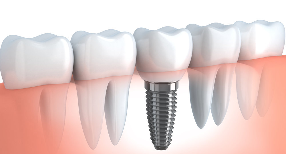 Learn about Implant Odontotheraphy, implant applications, implant applications in Turkey