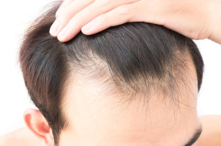 Your guidebook of hair transplant Turkey- Treatment, Expectations & Risks